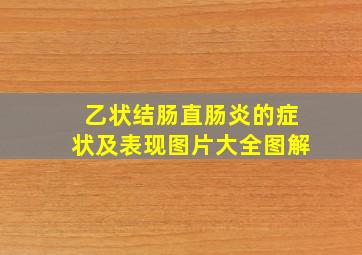 乙状结肠直肠炎的症状及表现图片大全图解