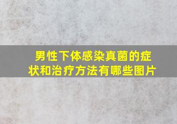 男性下体感染真菌的症状和治疗方法有哪些图片