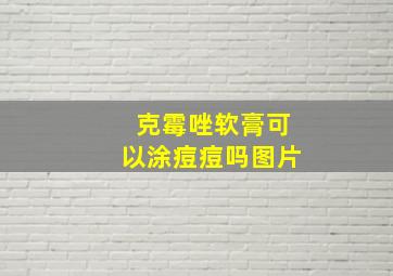 克霉唑软膏可以涂痘痘吗图片