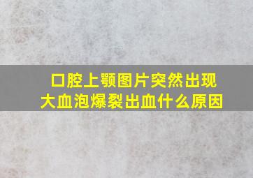 口腔上颚图片突然出现大血泡爆裂出血什么原因