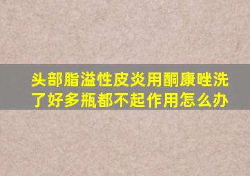 头部脂溢性皮炎用酮康唑洗了好多瓶都不起作用怎么办